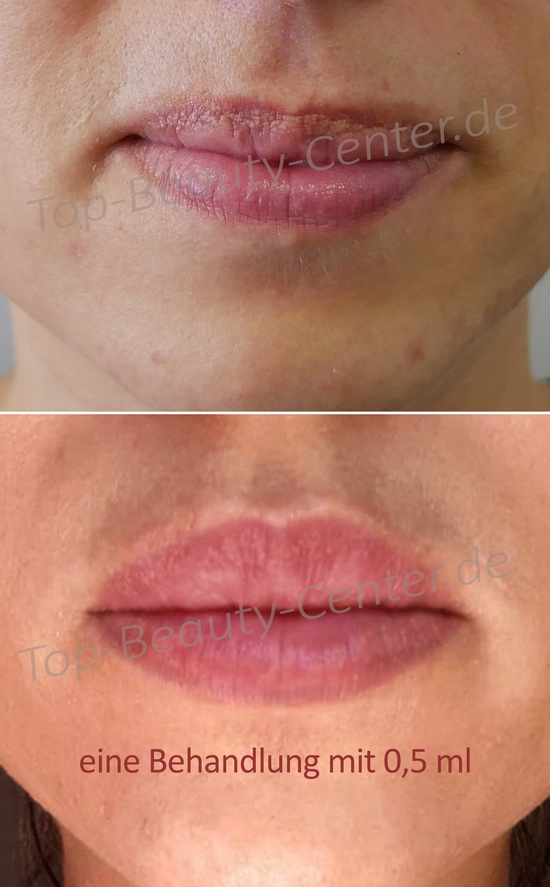 Lippen-Hyaluron-Ohne-Nadel-Giessen